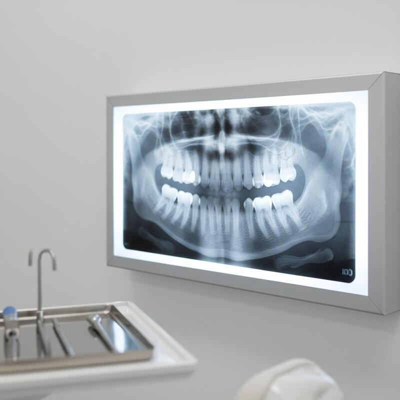 Should I Have My Wisdom Teeth Removed?